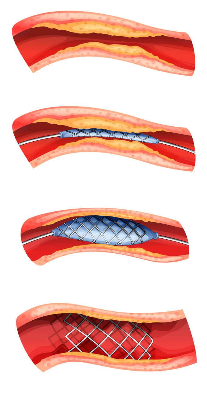 Illustration des Stent-Einsatzes in eine Arterie mittels eines Ballons, der die Arterie weitet und den Stent sichert, dargestellt in der Radiologie Föhren.