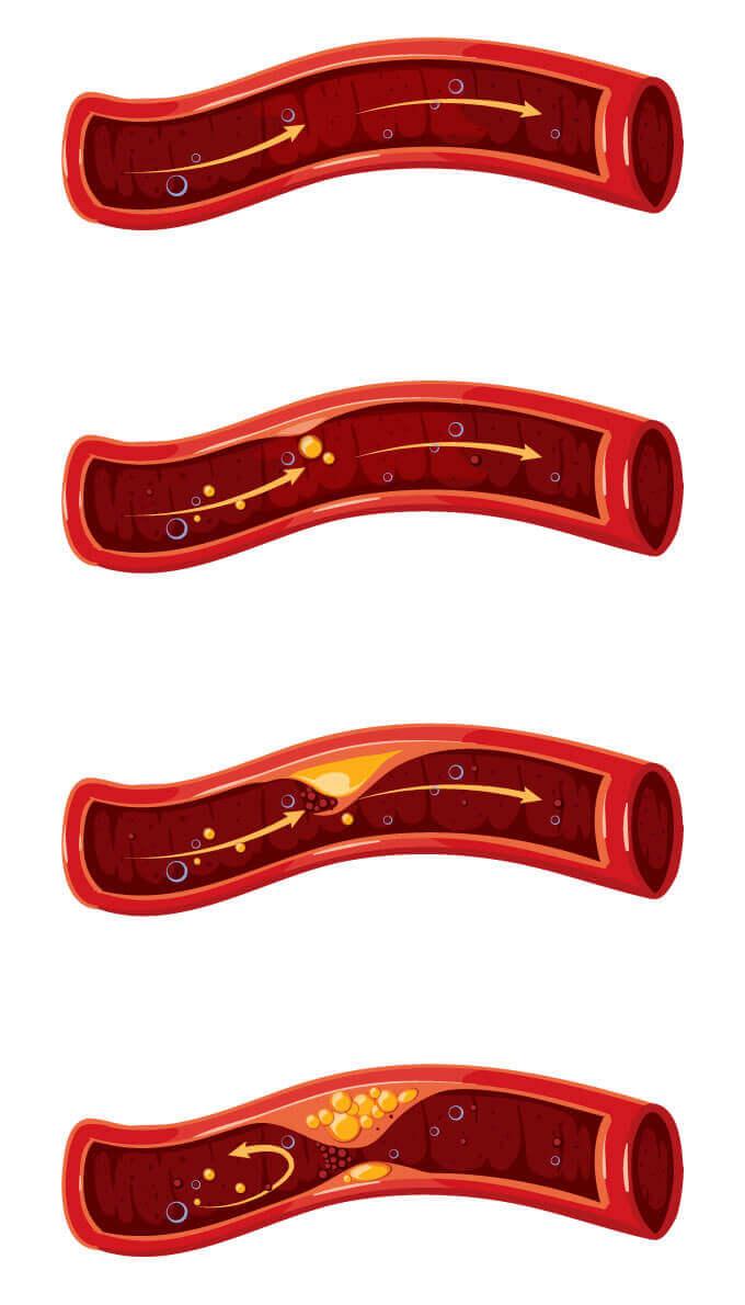 Illustration zeigt eine Arterie und die fortschreitende Arterienverkalkung, frühzeitig erkennbar durch Kardio-CT Computertomographie in der Radiologie Föhren.